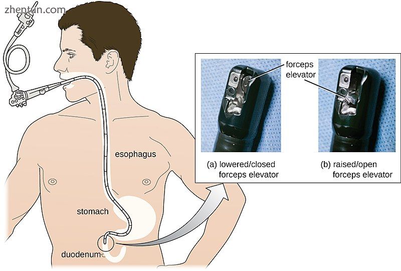 Gastroscopy or duodenoscopy is performed for a number of indications, one of the.jpg