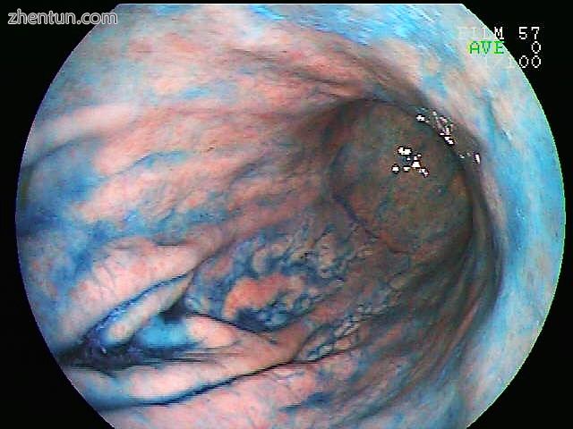 Indigo carmine staining (stomach).jpg