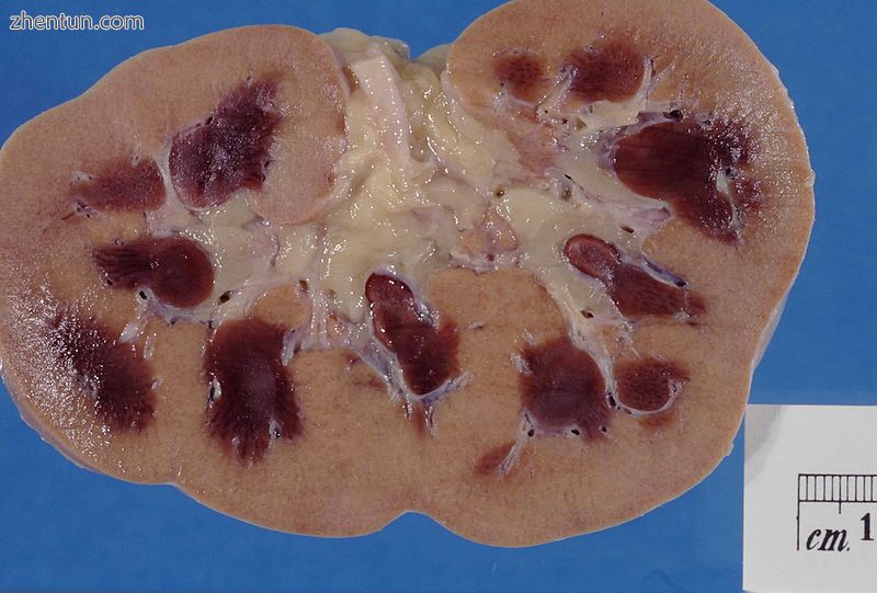 Pathologic kidney specimen showing marked pallor of the cortex, contrasting to t.jpg