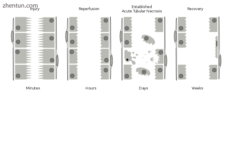 Pathophysiology of acute kidney injury in the proximal renal tubule.png