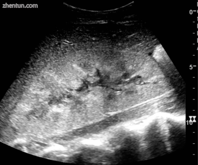 Renal ultrasonograph in renal failure after surgery with increased cortical echo.jpg