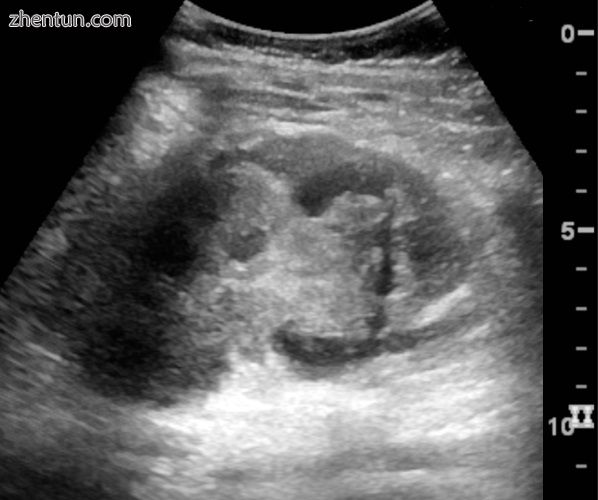 Renal ultrasonograph in renal trauma with laceration of the lower pole and subca.jpg