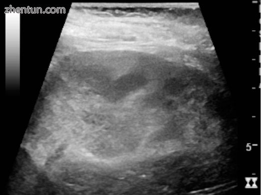 Renal ultrasonograph of acute pyelonephritis with increased cortical echogenicit.jpg