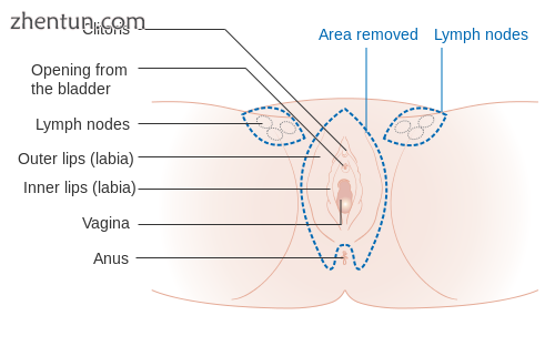 Diagram of the incisions made in a vulvectomy, a treatment for vulvar cancer.png