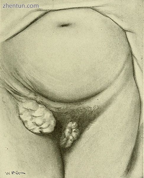 Drawing of cancer of the clitoris with spread to the groin.jpg