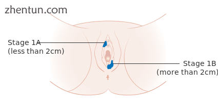 Stage 1A and 1B vulvar cancer.png