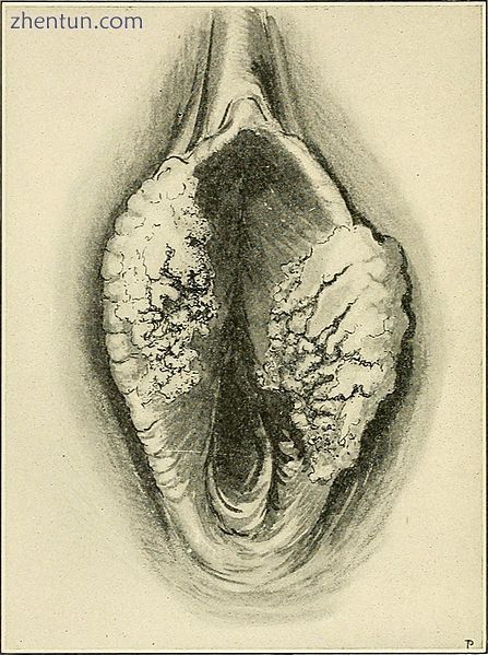 Drawing of vulvar cancer.jpg