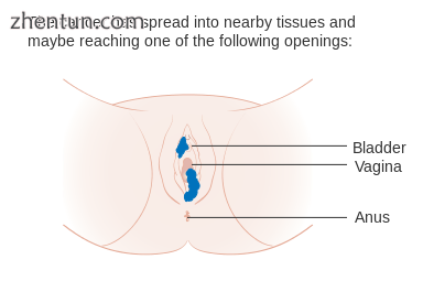 Stage 2 vulvar cancer.png