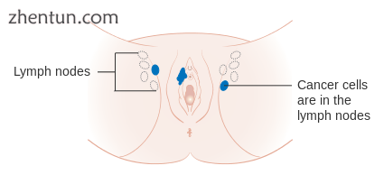 Stage 3 vulvar cancer.png