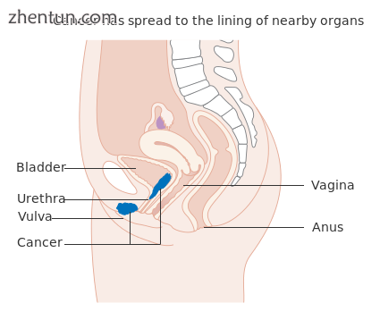 Stage 4A vulvar cancer.png