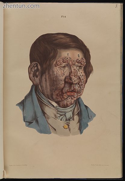 A 13-year-old boy with severe leprosy.jpg