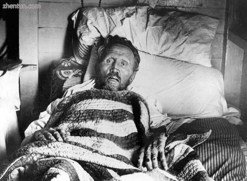 Father Damien on his deathbed in 1889.jpg