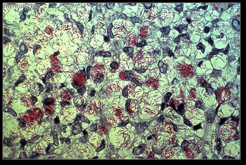 M. leprae, one of the causative agents of leprosy As an acid-fast bacterium, M. .jpg