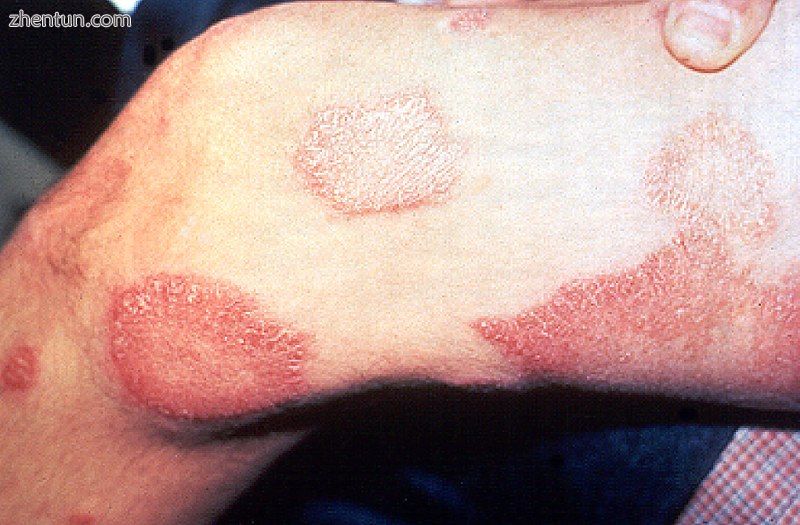 Skin lesions on the thigh of a person with leprosy.jpg