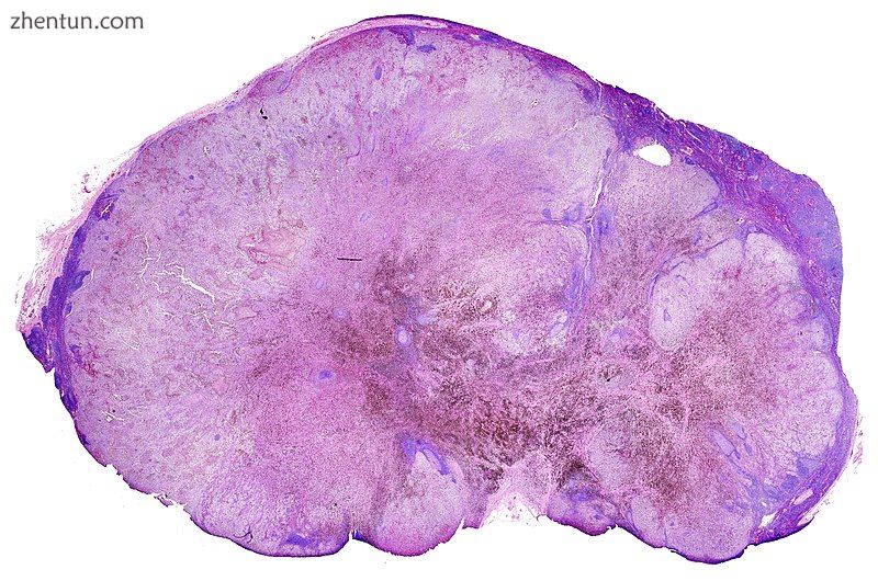 Lymph node with almost complete replacement by metastatic melanoma. The brown pi.jpg