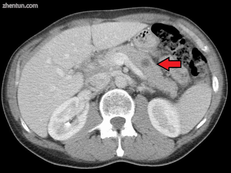 Metastases from the lungs to the pancreas.png