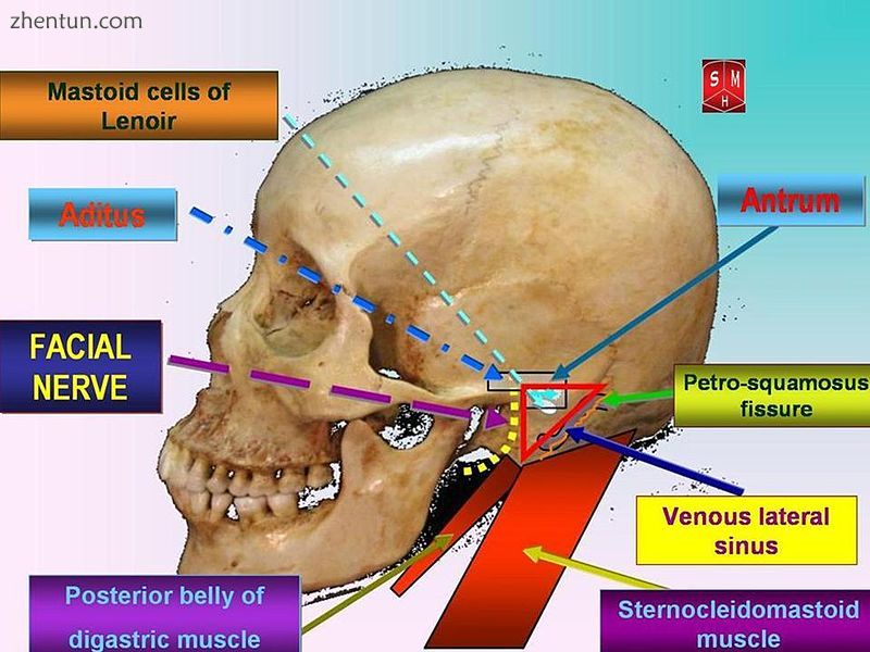 Attack triangle in mastoidectomies.jpg