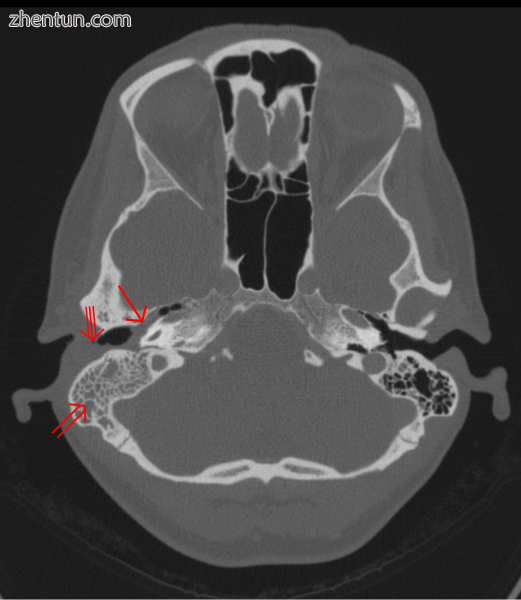 CT scan Otitis media (simple arrow) and mastoiditis (double arrow) of the right .png