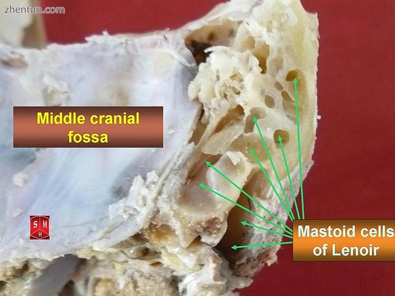 Mastoid cells of Lenoir.jpg