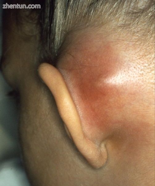 Mastoiditis with subperiostal abscess.jpg