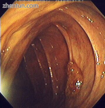 Polyp is identified..jpg