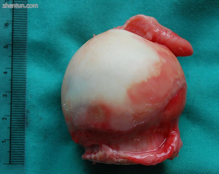 Gross pathology specimen of the head of the femur with some synovium attached at.jpg