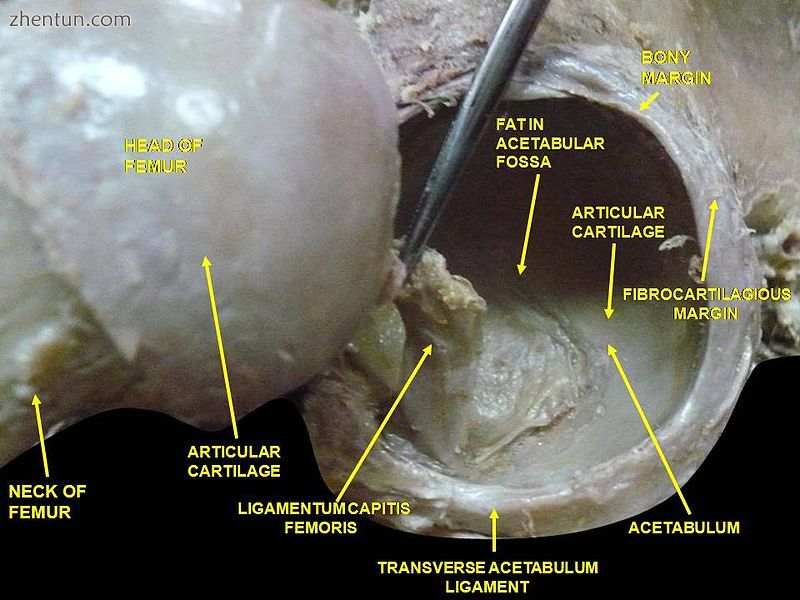 Hip joint. 2Lateral view. Femur head.jpg