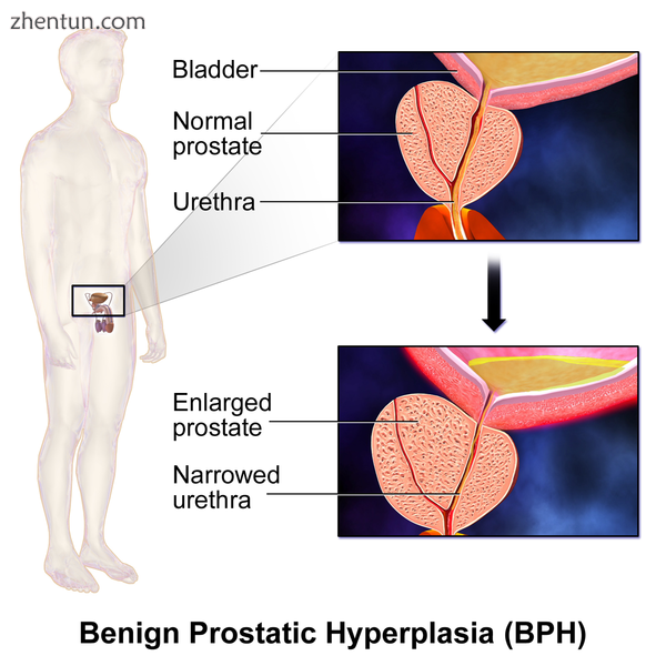 Benign Prostatic Hyperplasia (BPH).png