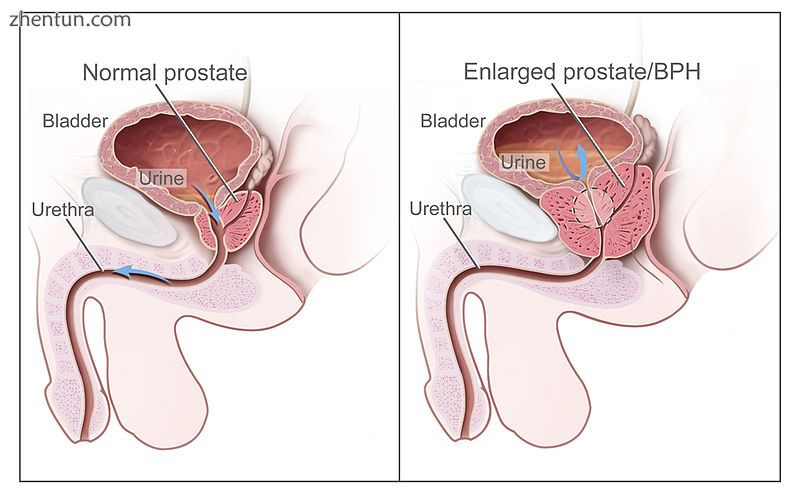 Diagram of a normal prostate (left) and benign prostatic hyperplasia (right).jpg