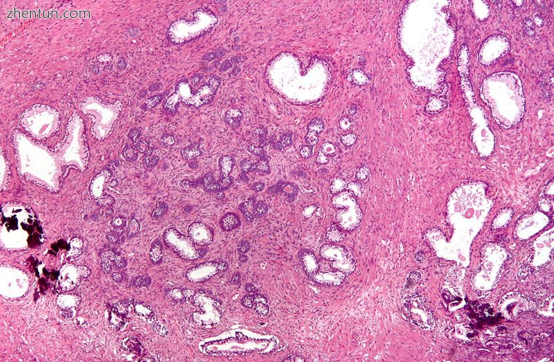 Micrograph showing nodular hyperplasia (left off center) of the prostate from a .jpg