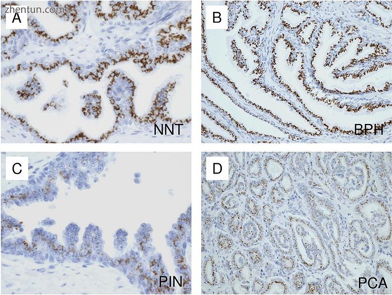 Microscopic examination of different types of prostate tissue.jpg