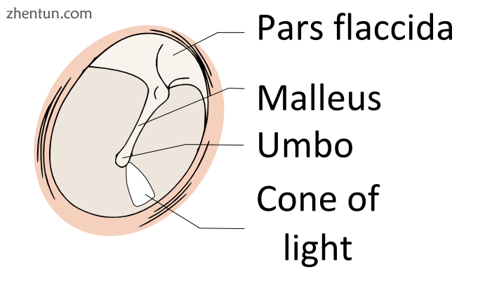 Right eardrum2 as seen through a speculum..png