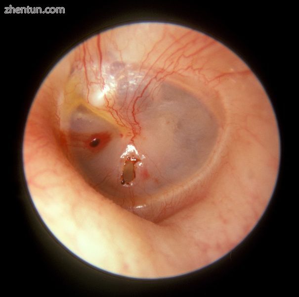 The oval perforation in this left tympanic membrane was the result of a slap on .jpg