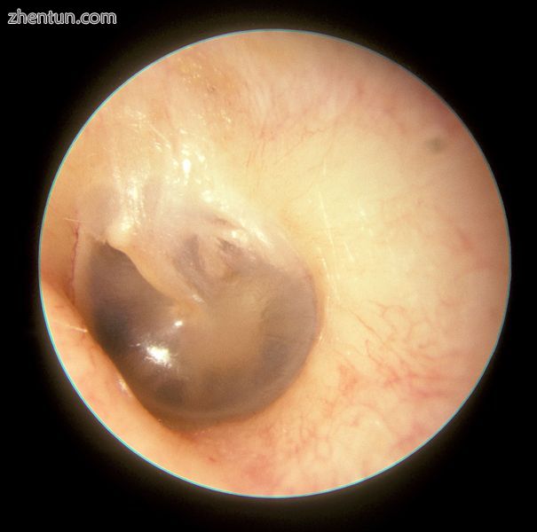 This is a normal left eardrum..jpg
