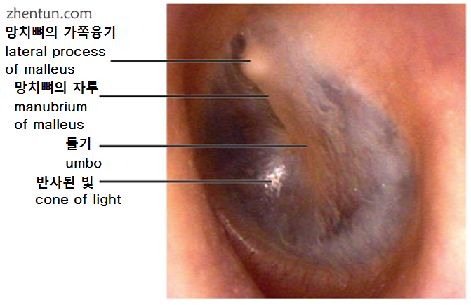Tympanic membrane viewed by otoscope.png
