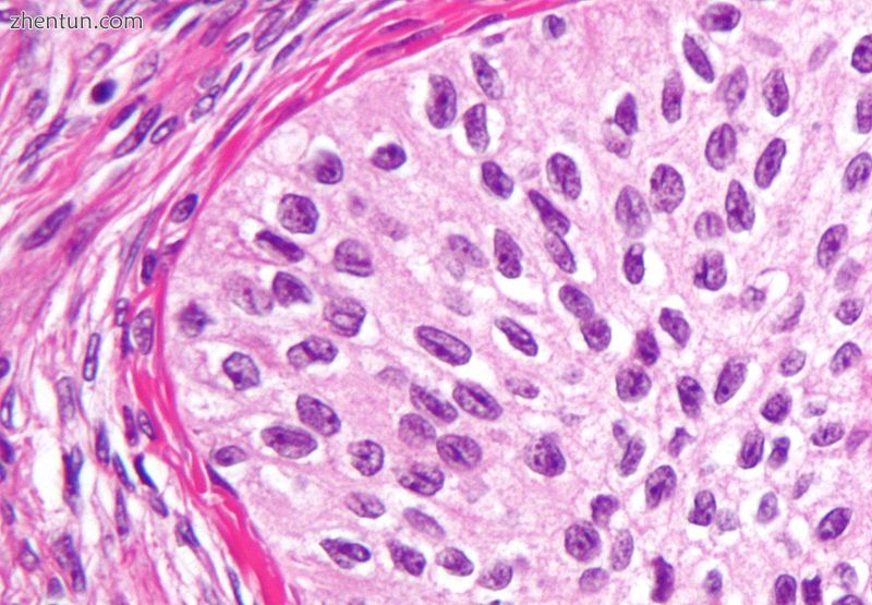 High magnification micrograph of a Brenner tumor, a type of surface epithelial-s.jpg