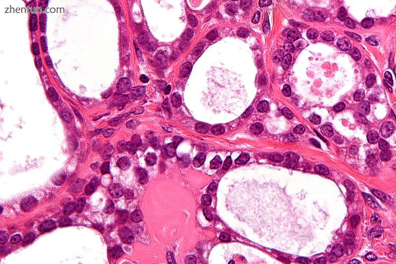 Micrograph of an ovarian clear cell carcinoma. H&amp;E stain..jpg