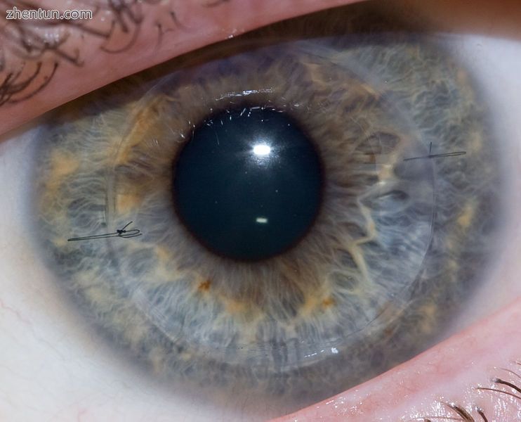 Cornea transplant after one year of healing, two stitches are visible.jpg