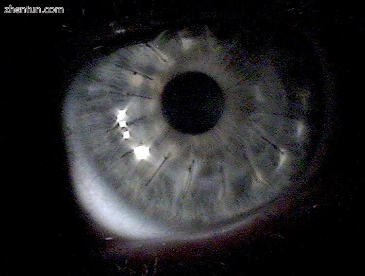 Cornea transplant approximately one week after surgery. Multiple light reflectio.jpg