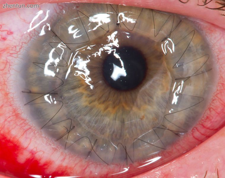 Cornea transplant one day after surgery..jpg