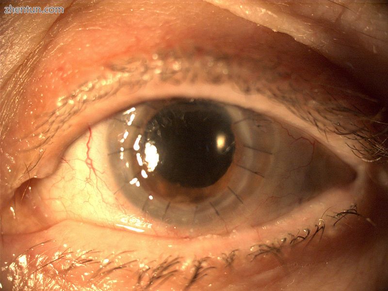Replacement of the entire cornea.JPG
