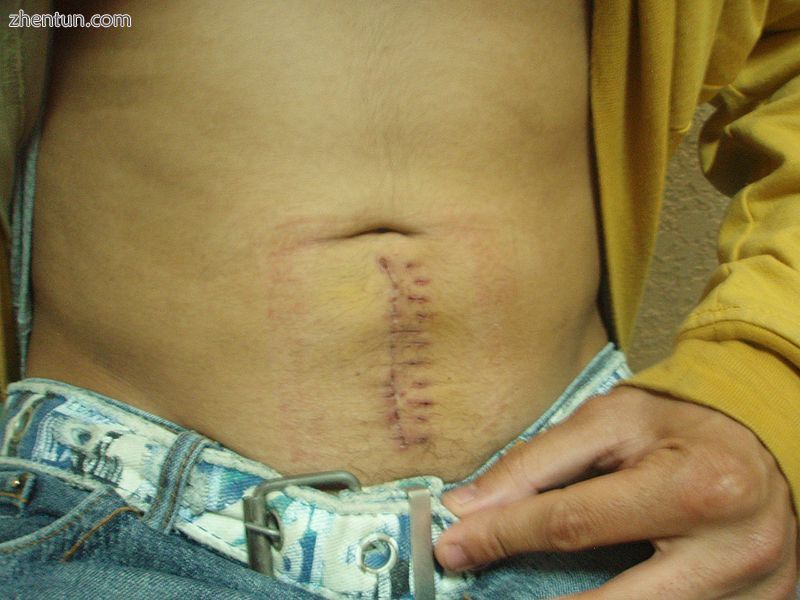 Scar 10 days after operation.jpg