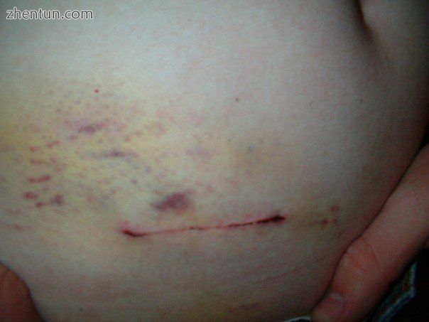 Scar and bruise 2 days after operation.jpg