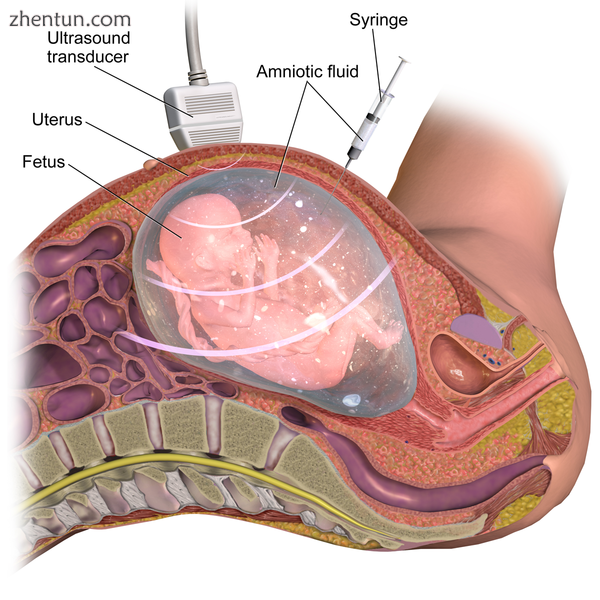 Amniocentesis.png