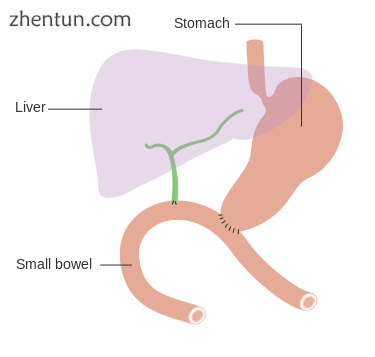 Diagram showing how the bowel is joined back together after a total pancreatectomy.png