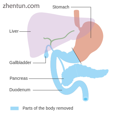 Diagram showing the area removed for a total pancreatectomy.png