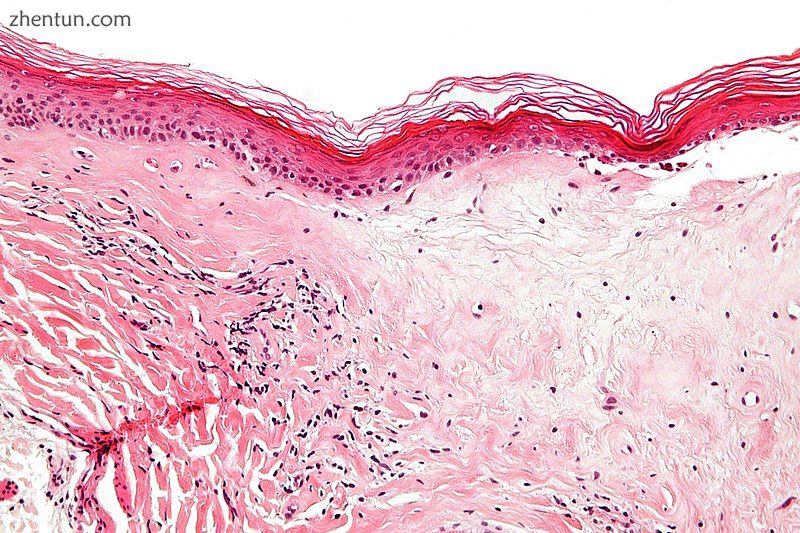 Micrograph of lichen sclerosus showing the characteristic subepithelial sclerosus.jpg