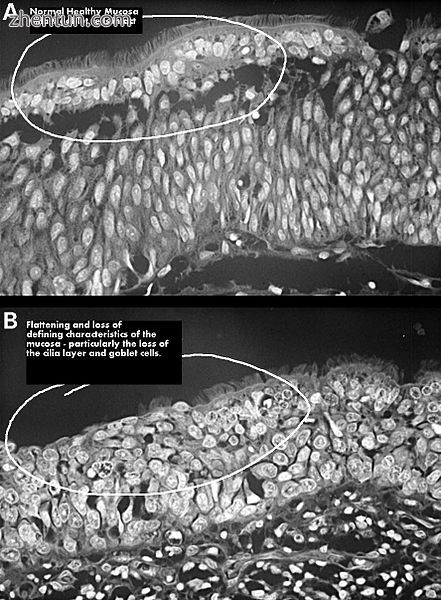 Squamous metaplasia of nasal respiratory epithelium..jpg