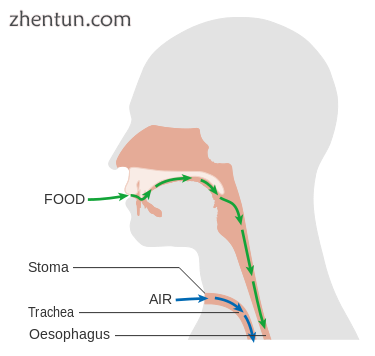 Anatomical changes following a laryngectomy.png