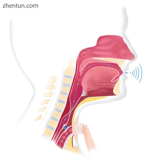 Voice prosthesis.jpg